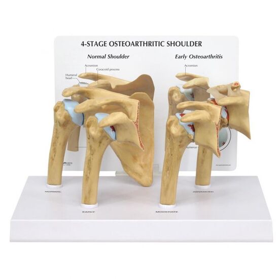4 Stage Osteoarthritis (OA) Shoulder Model