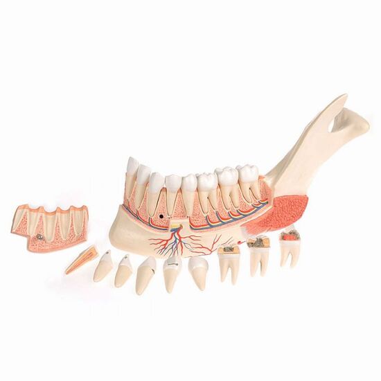 Comprehensive Lower Jaw Model (Left Half) with Diseased Teeth, Nerves, Vessels & Glands, 19 part – 3B Smart Anatomy