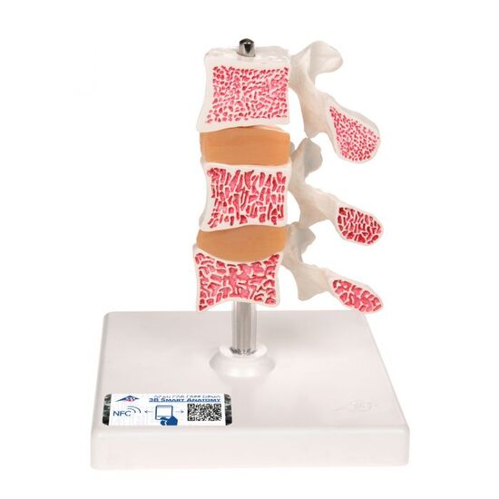Deluxe Human Osteoporosis Model (3 Vertebrae with Discs ), Removable on Stand – 3B Smart Anatomy