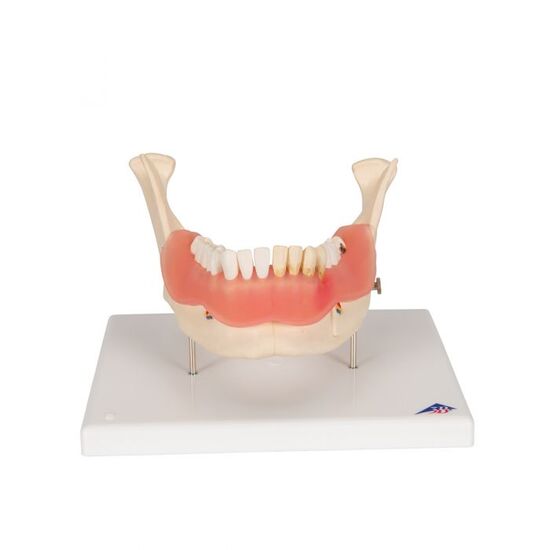 Dental Disease Model, Magnified 2 times, 21 parts – 3B Smart Anatomy