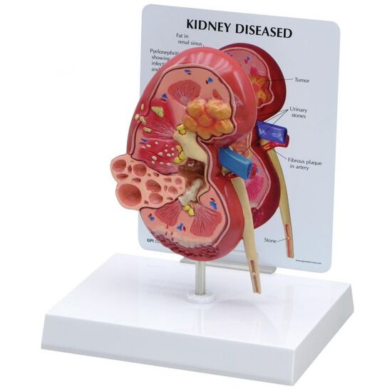 Diseased Kidney Model