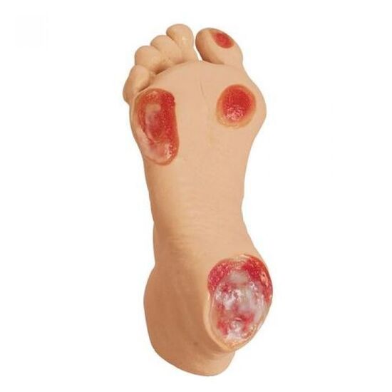 Elderly Pressure Ulcer Foot