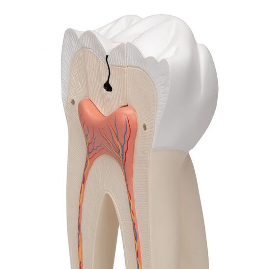 Giant Molar with Dental Cavities Human Tooth Model, 15 times Life