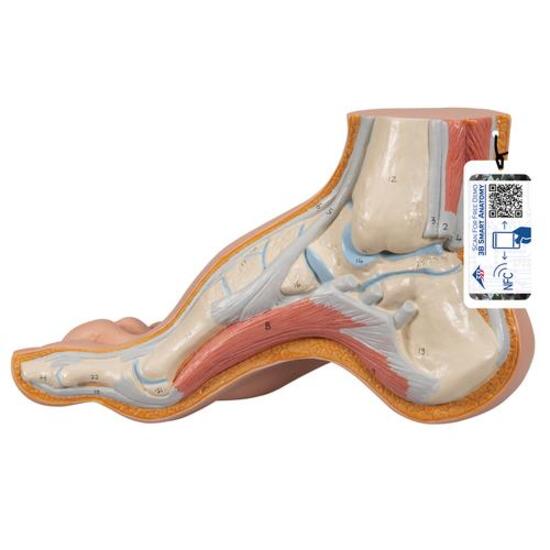 Hollow Foot (Pes Cavus) Model – 3B Smart Anatomy