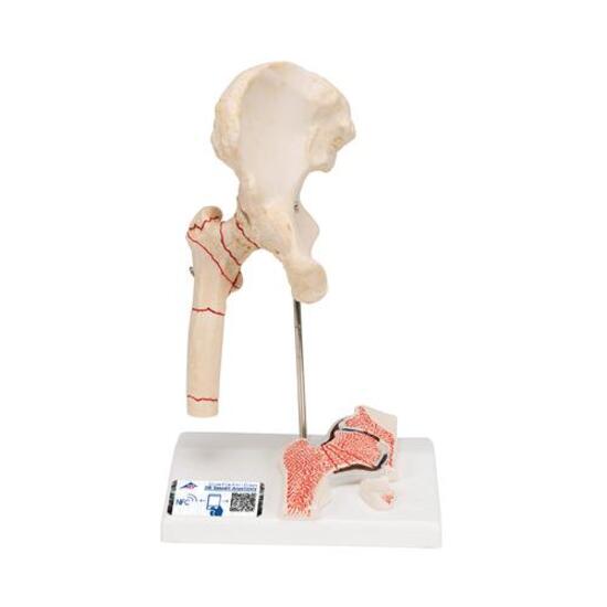 Human Femoral Fracture & Hip Osteoarthritis Model – 3B Smart Anatomy