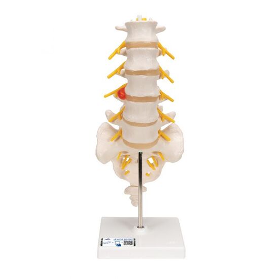 Human Lumbar Spinal Column Model with Dorso-Lateral Prolapsed Intervertebral Disc – 3B Smart Anatomy