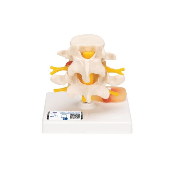 Human Lumbar Spinal Column with Prolapsed Intervertebral Disc – 3B Smart Anatomy
