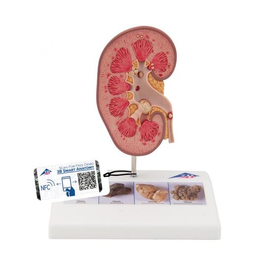 Kidney Stone Model – 3B Smart Anatomy