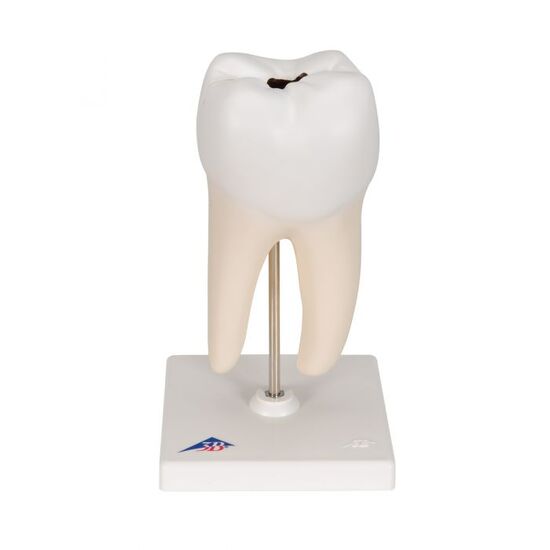 Lower Twin-Root Molar with Cavities Human Tooth Model, 2 part – 3B Smart Anatomy