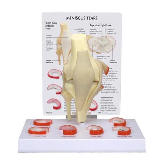 Meniscus Knee Model with 6 Tears