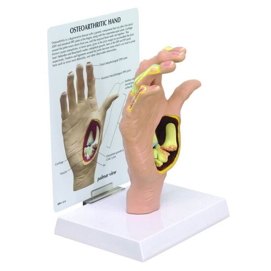 Osteoarthritis Hand Model