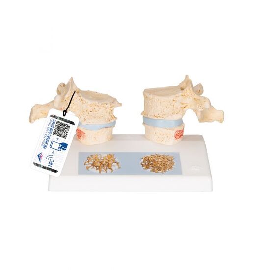 Osteoporosis Didactic Model – 3B Smart Anatomy