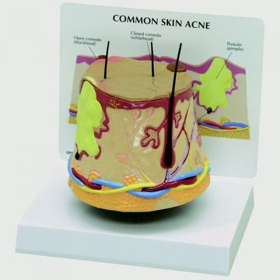 Skin Acne Model (oversize)