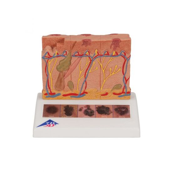 Skin Cancer Model with 5 stages, 8 times magnified – 3B Smart Anatomy