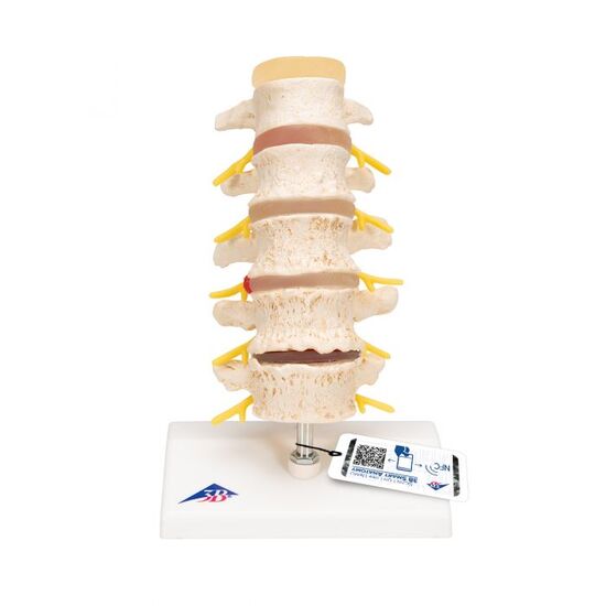 Stages of Disc Prolapse and Vertebral Degeneration - 3B Smart Anatomy