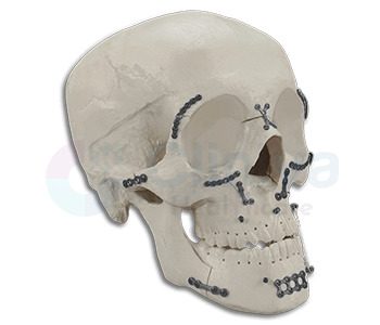 Craniomaxillofacial Implants